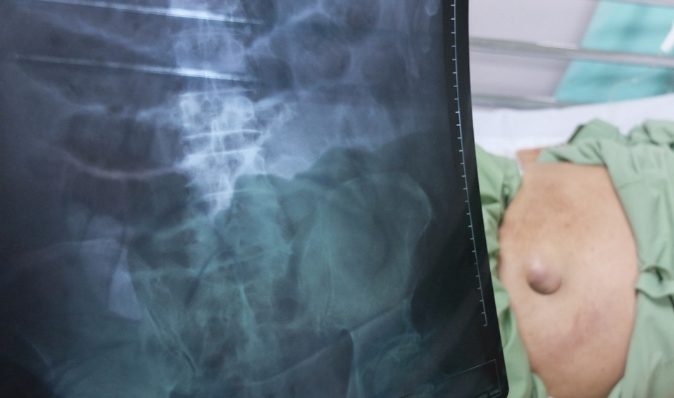 best incisional hernia treatment in Pune